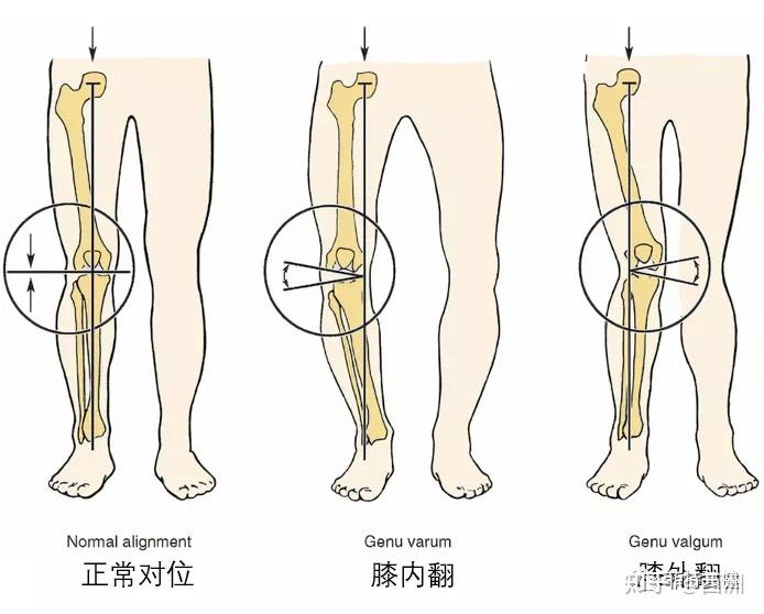 膝关节外翻测量图示图片