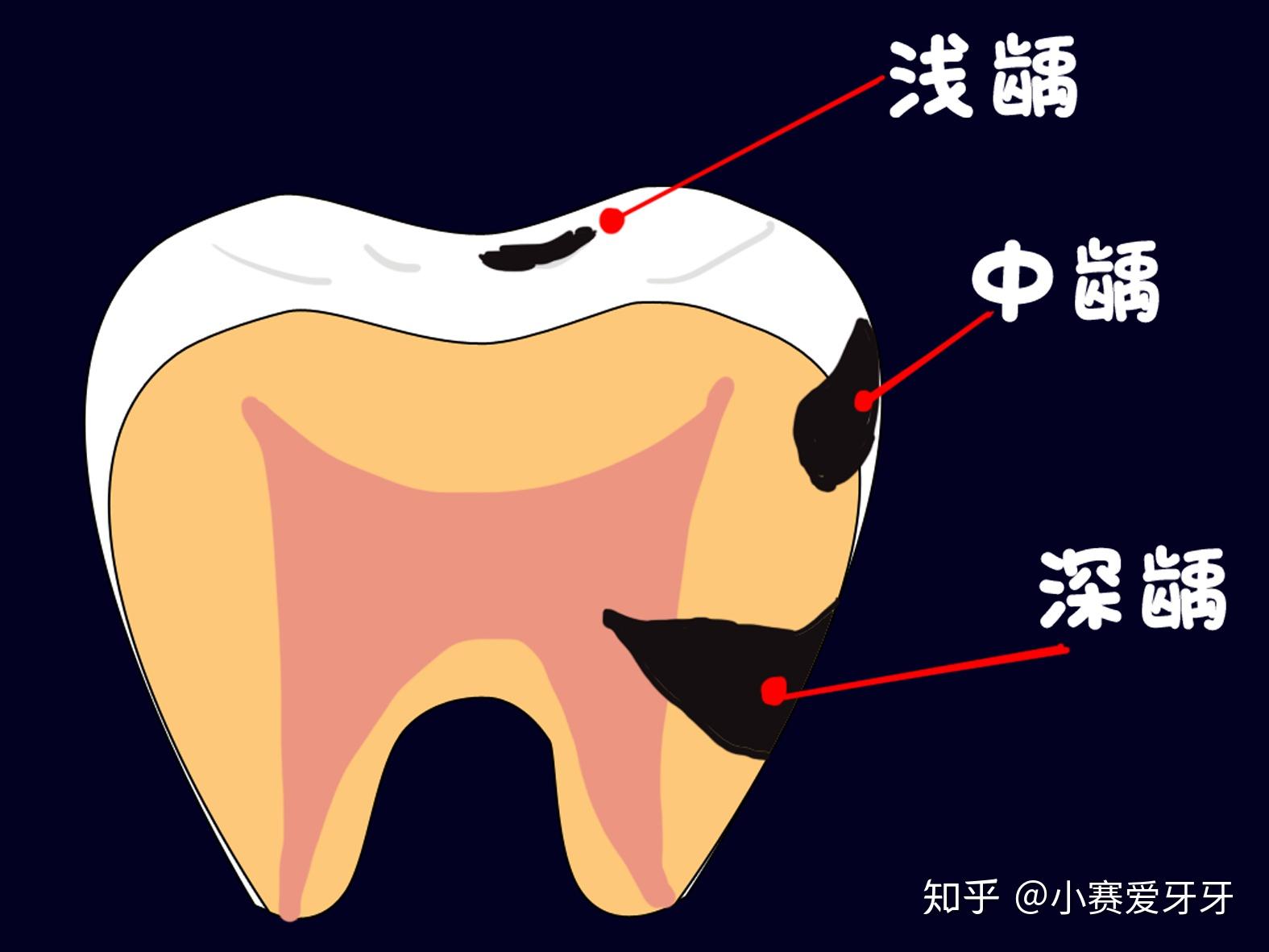 牙齿上的黑洞千万不能忽视！！！记录一下人生中第一次补牙的经历~ - 知乎