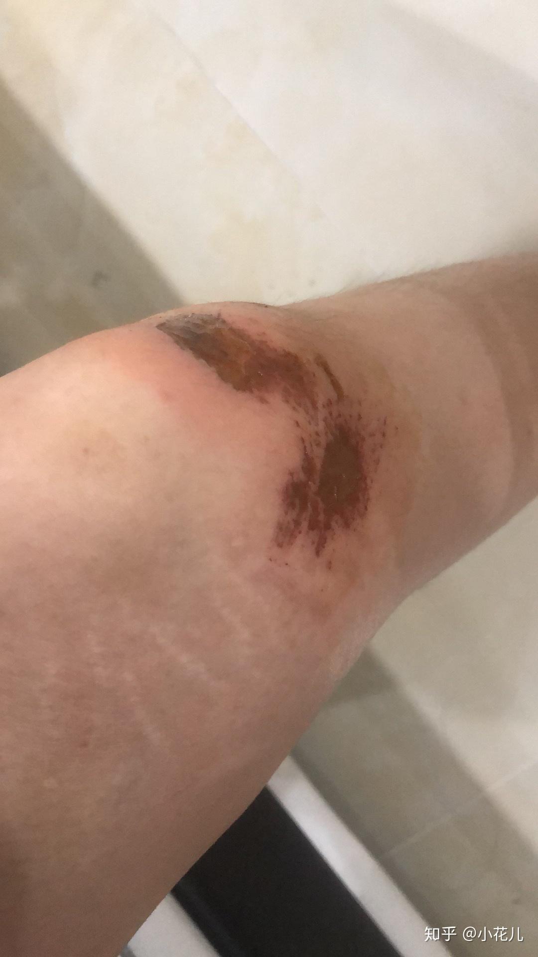 双膝擦伤恢复去疤纪录贴