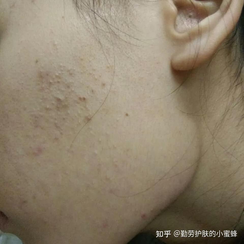 【护肤干货】拯救闭口脸|皮肤科医生教你4招,科学有效去除闭口粉刺~素颜出门的快乐谁懂! - 知乎
