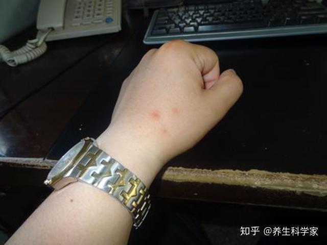 这种痣可能是肝癌信号肝病医生这3种护肝食物不妨多吃