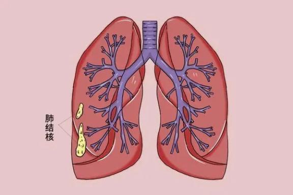 肺结核能治好吗早期图片