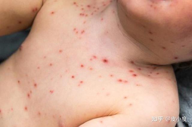 夏天得了水痘最是麻烦家里老人小孩多关注