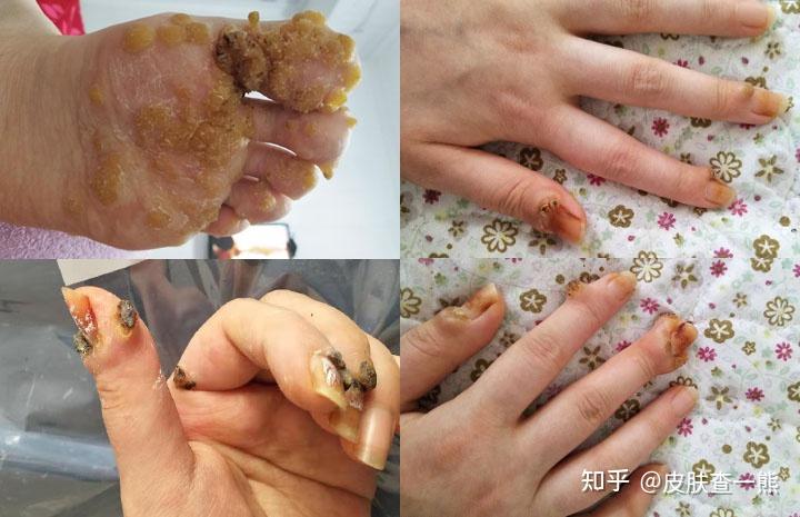 查说hpv疣说说乳头瘤病毒的那些事儿