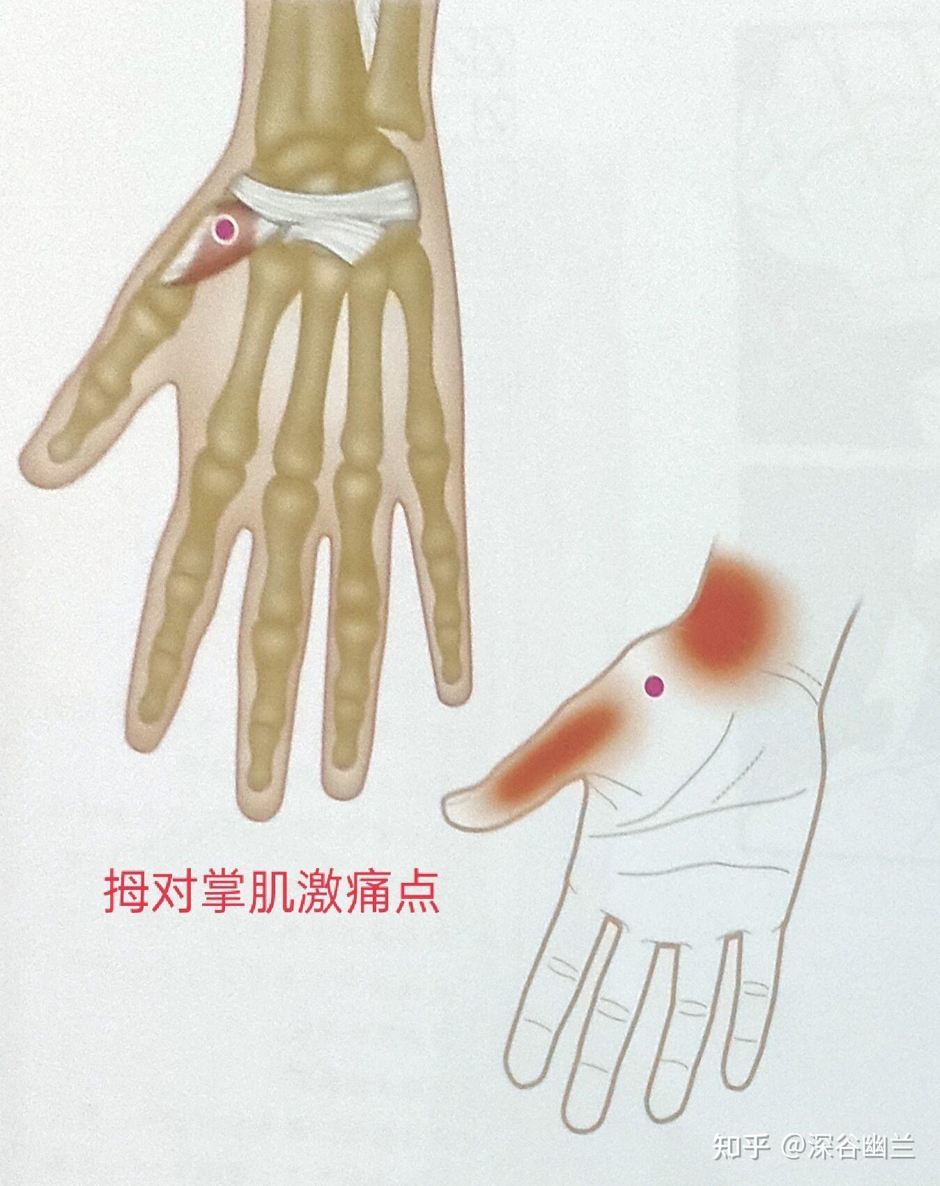 拇收肌激痛点牵涉痛从拇指背面和掌面局部至掌指关节周围的疼痛,辐射