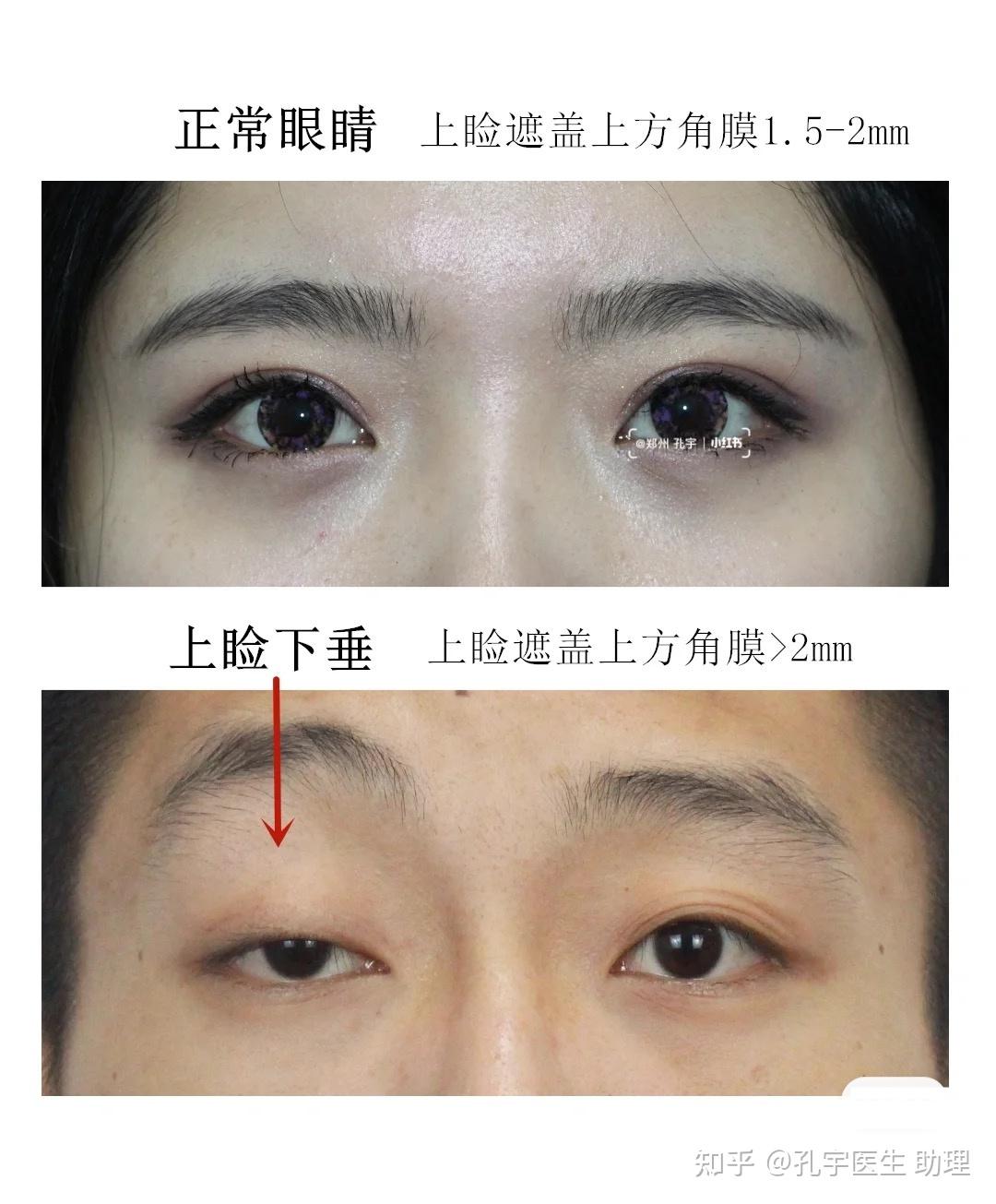 先天性上睑下垂--与遗传有关1,单纯性上睑下垂(单眼或双眼)2,上睑下垂