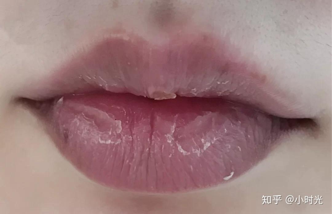 嘴唇总是干燥起死皮怎么办
