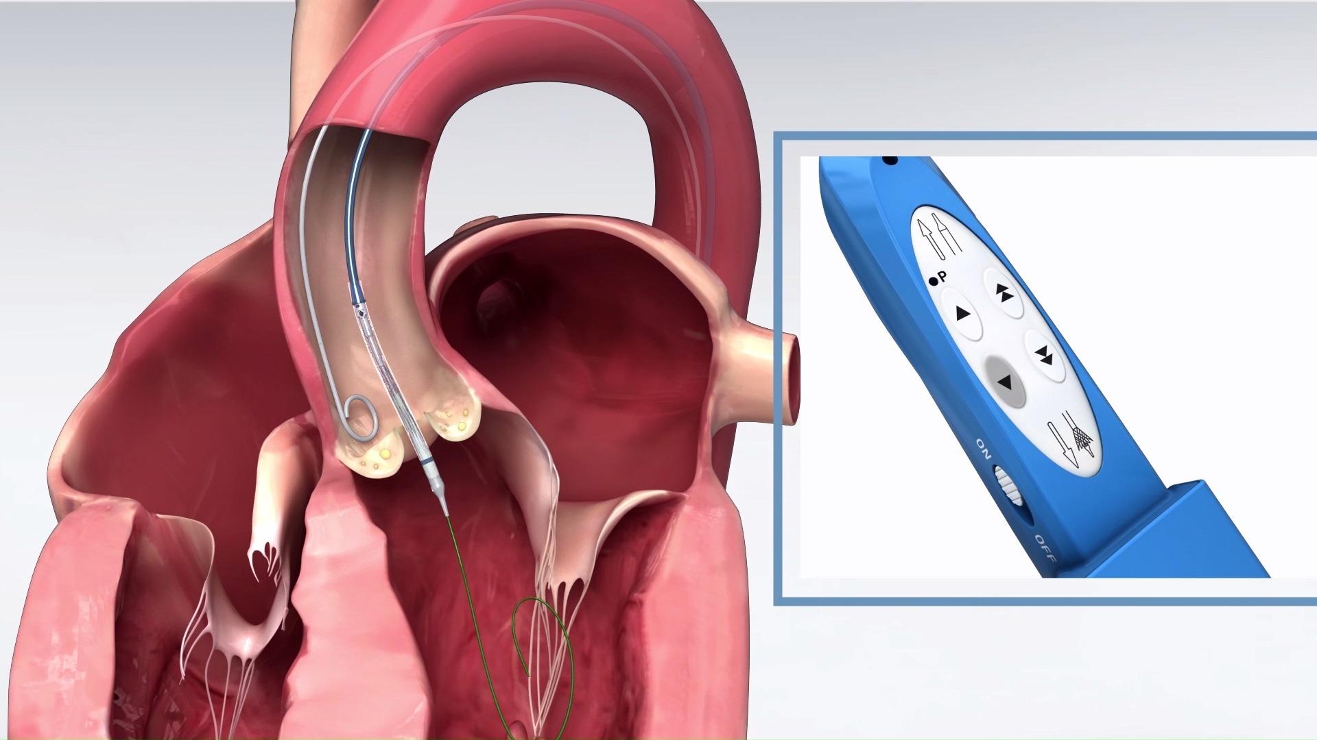 一种心脏微创手术,即经导管主动脉瓣置换手术(transcatheter aortic