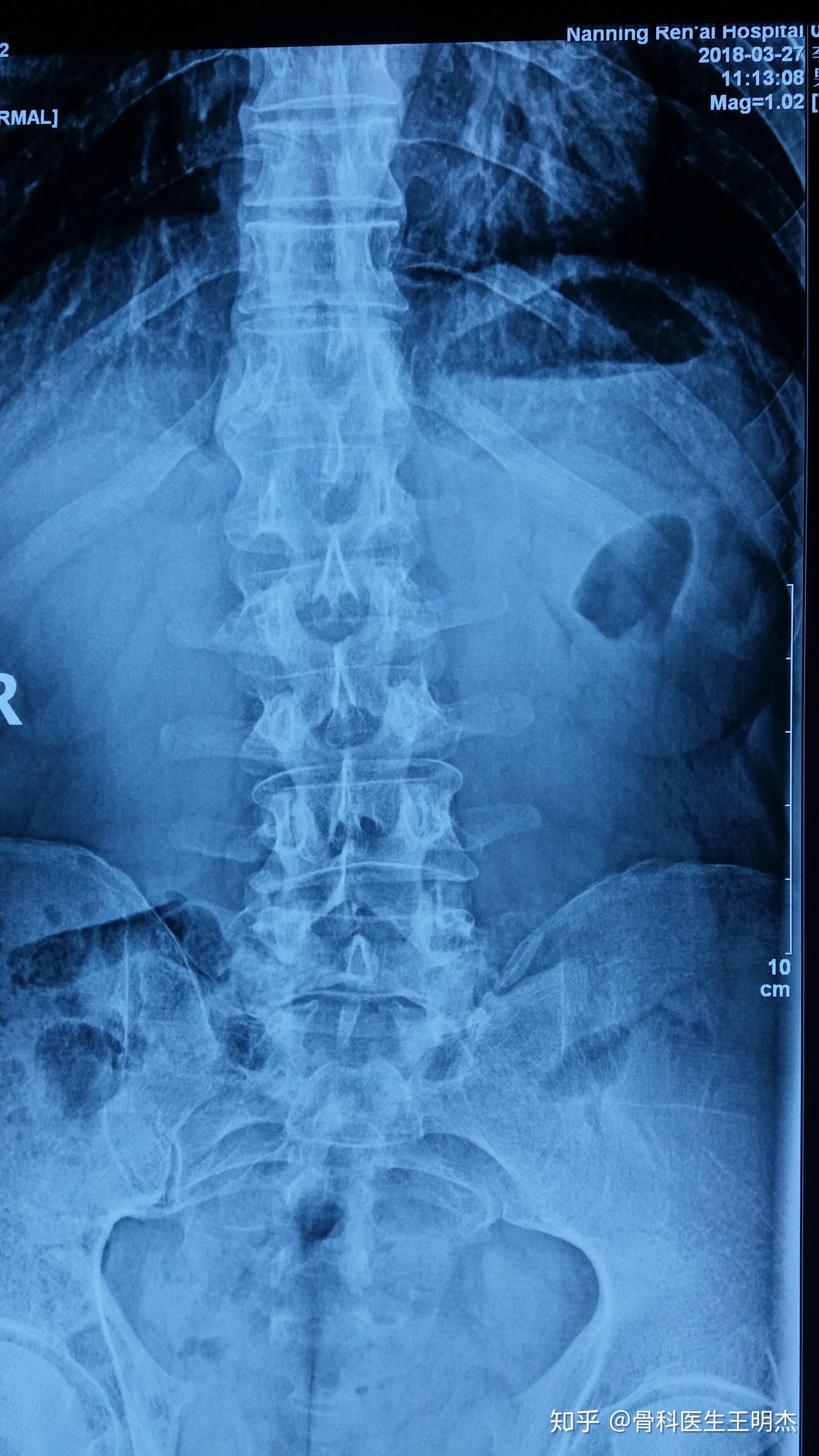 腰椎受伤有哪些治疗手段