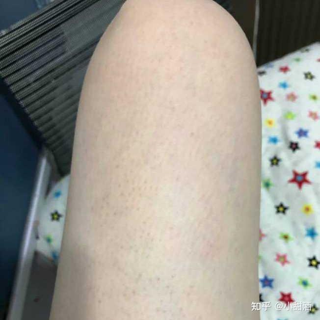 小腿鸡皮肤改善毛孔变大(大腿皮肤毛孔粗大像鸡皮疙瘩怎么改善) 小腿鸡皮肤改善毛孔变大(大腿皮肤毛孔粗大像鸡皮疙瘩怎么改善)