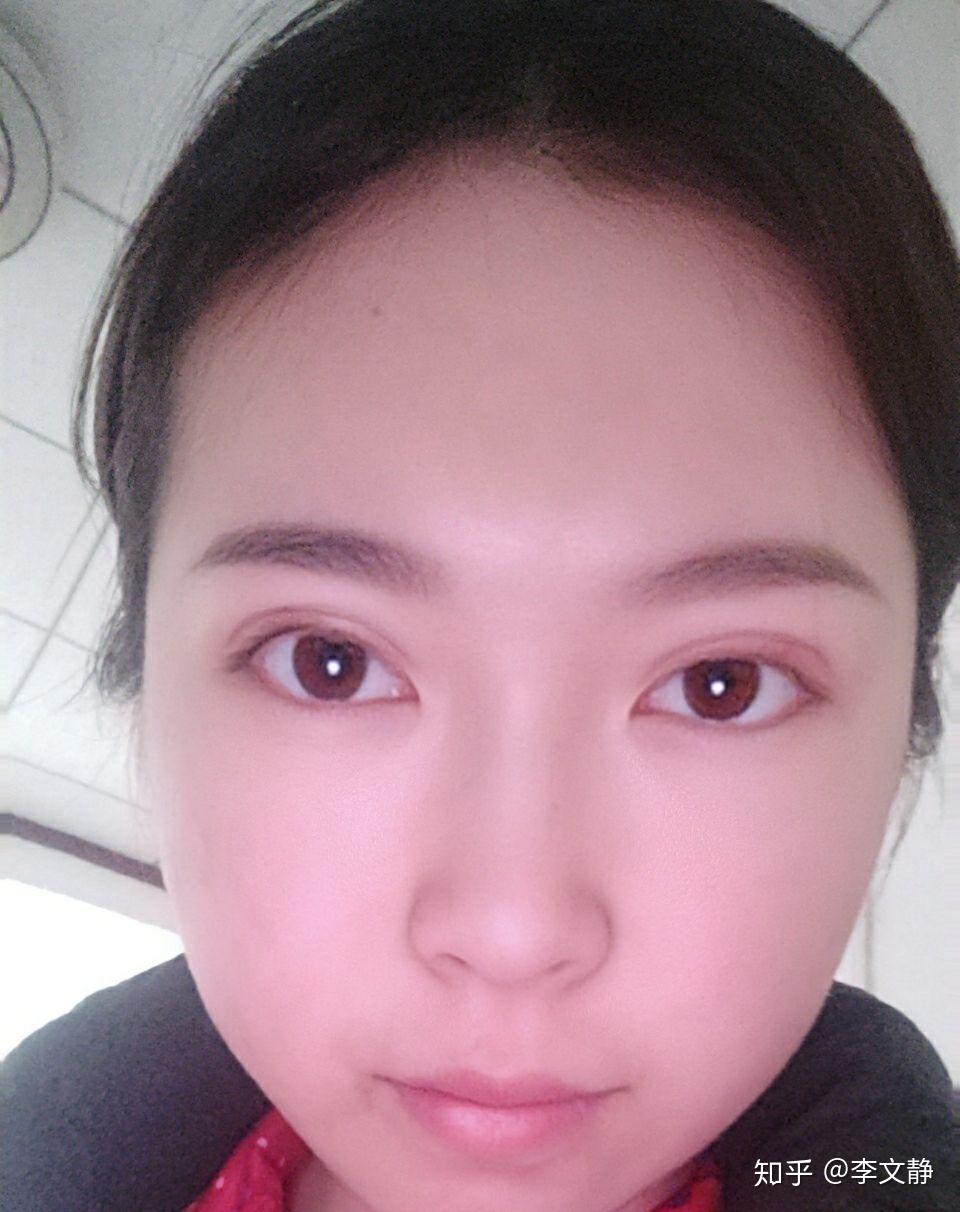 记录下双眼皮埋线的恢复过程