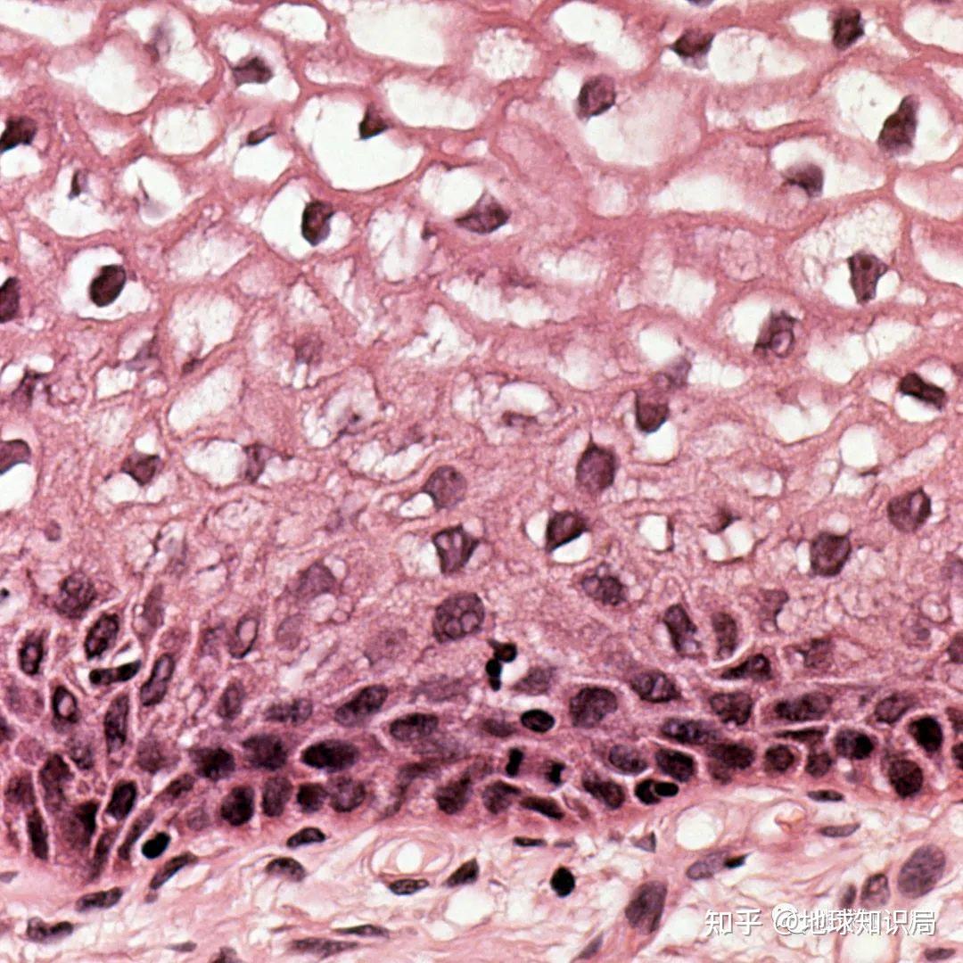 尖锐湿疣不只是长菜花地球知识局