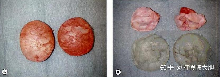 1,包膜挛缩:由于人体对于异物的排异反应,会在假体周围形成一层包膜