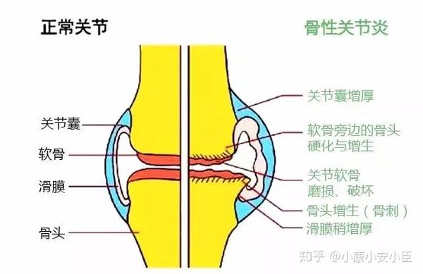 膝盖痛千万不能忍 一文搞定膝关节炎 知乎