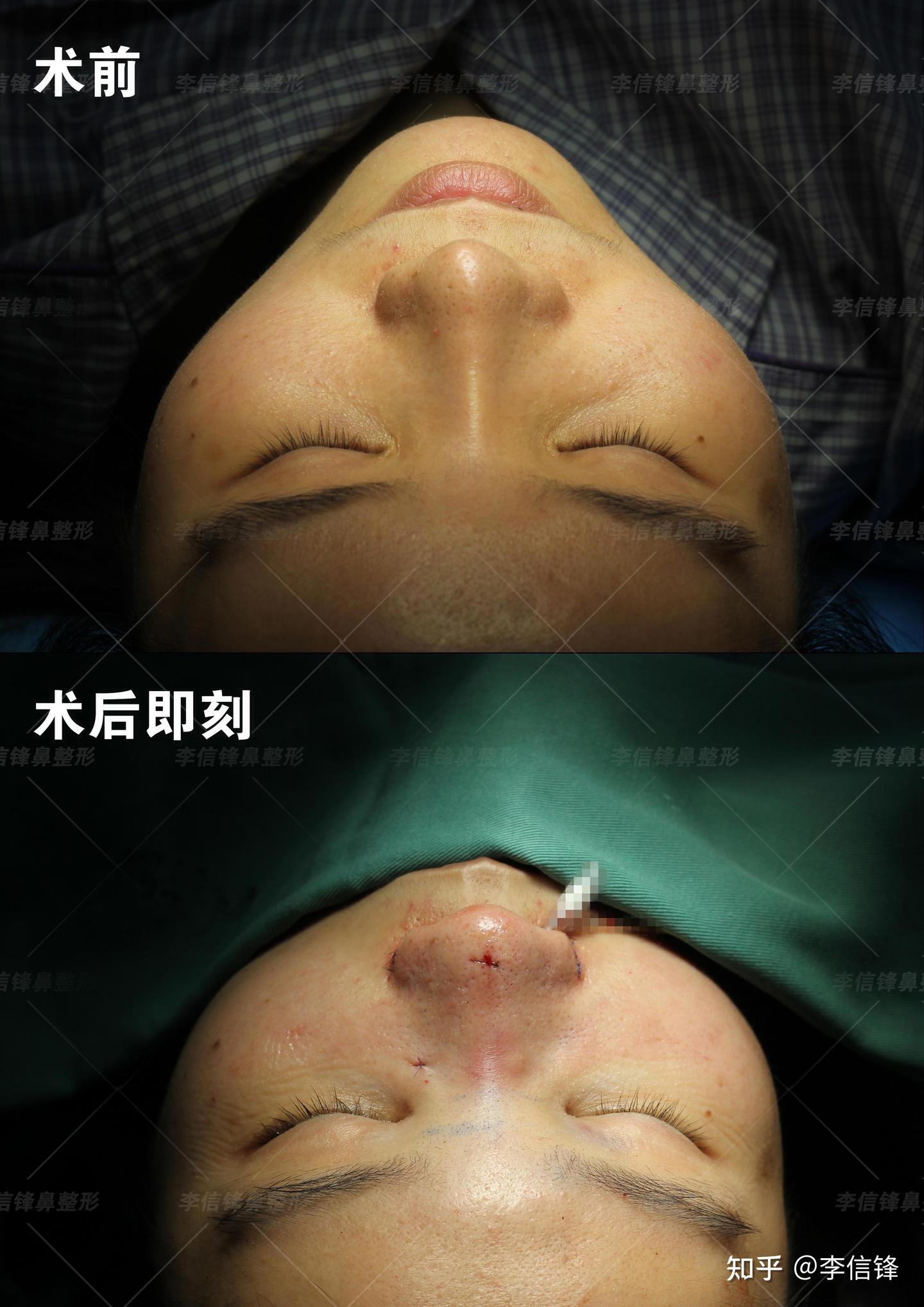 棍感、鼻头塌,鼻翼外扩鼻修复案例,术后即刻—深圳李信锋隆鼻综合整形 - 知乎