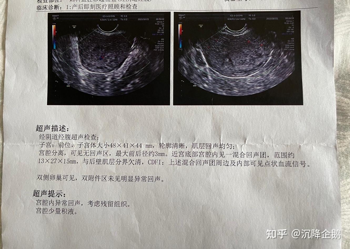 藥流加清宮後殘留的就診過程及心路歷程