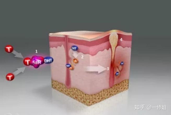图,我们可以清楚看到,过多的t(雄激素)被5ar(5alpha还原酶)转化成dht