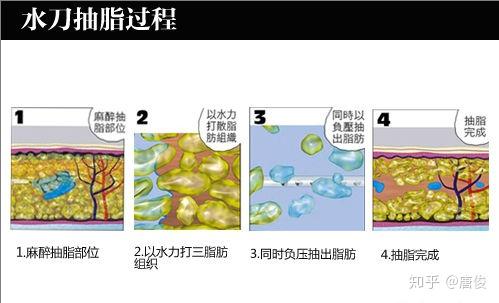 水动力吸脂和vaser威塑吸脂哪个更好 知乎