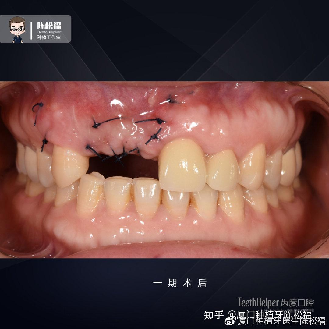 中国第一例EB全口种植牙全记录（四） - 知乎