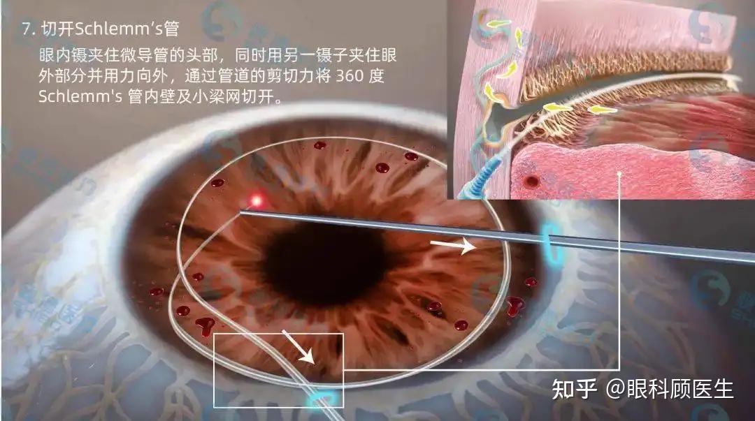 没有滤过泡的房角切开术 - 知乎