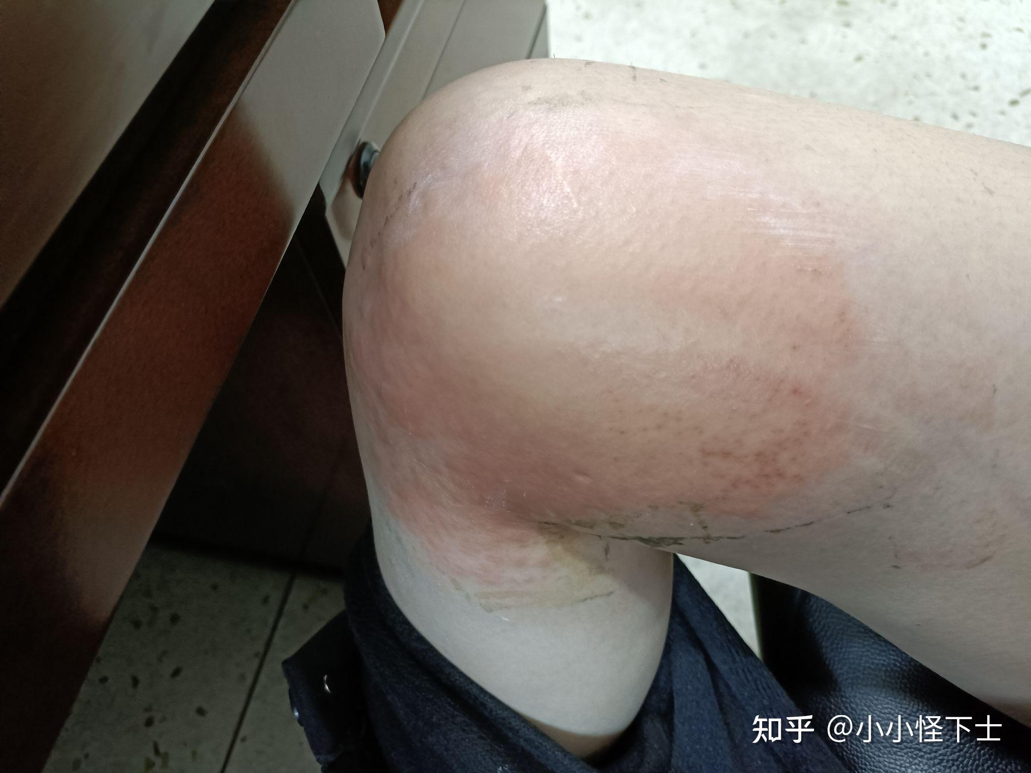 贴膏药导致的接触性皮炎