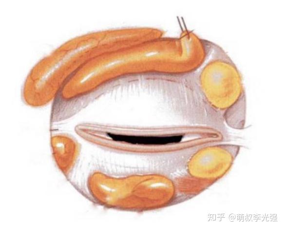 【萌叔一分钟科普】肿泡眼的你，知道该怎么办吗？ - 知乎
