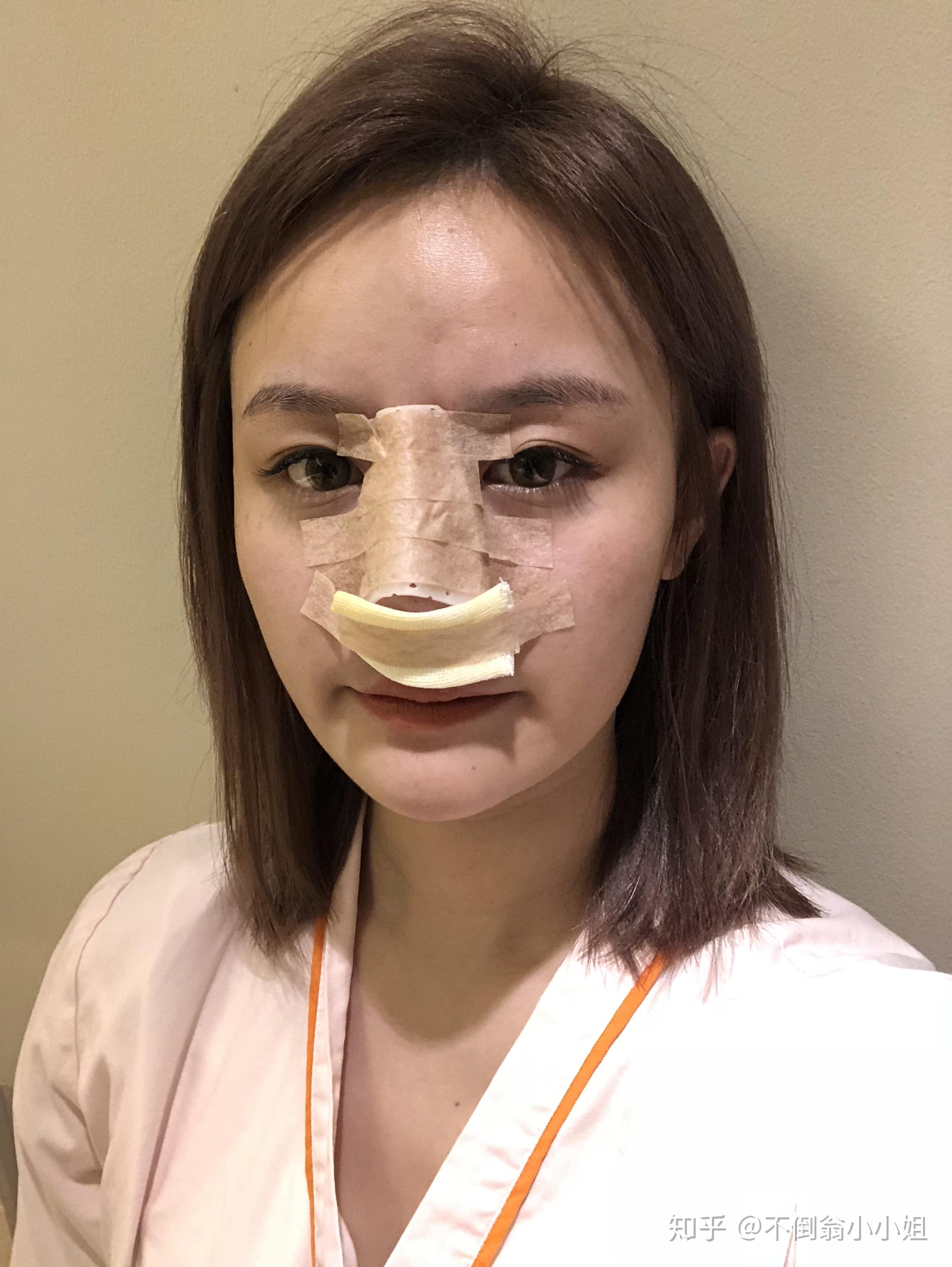 杭州做完鼻综合150天了整个人都变得精致啦医院医生哪里好