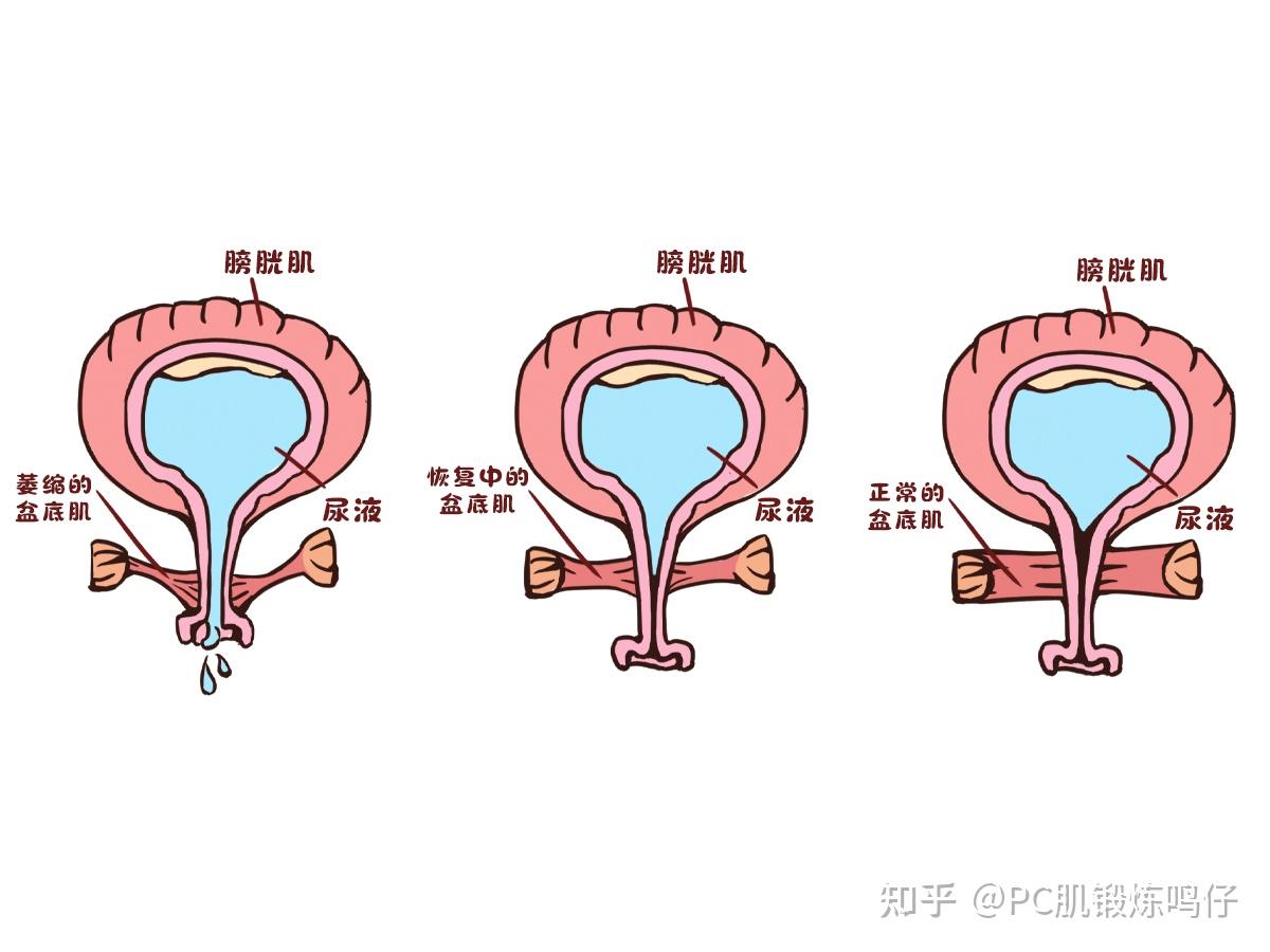 女性進行凱格爾運動鍛鍊時,不僅可以恢復盆底肌張力,同時還能增加下面