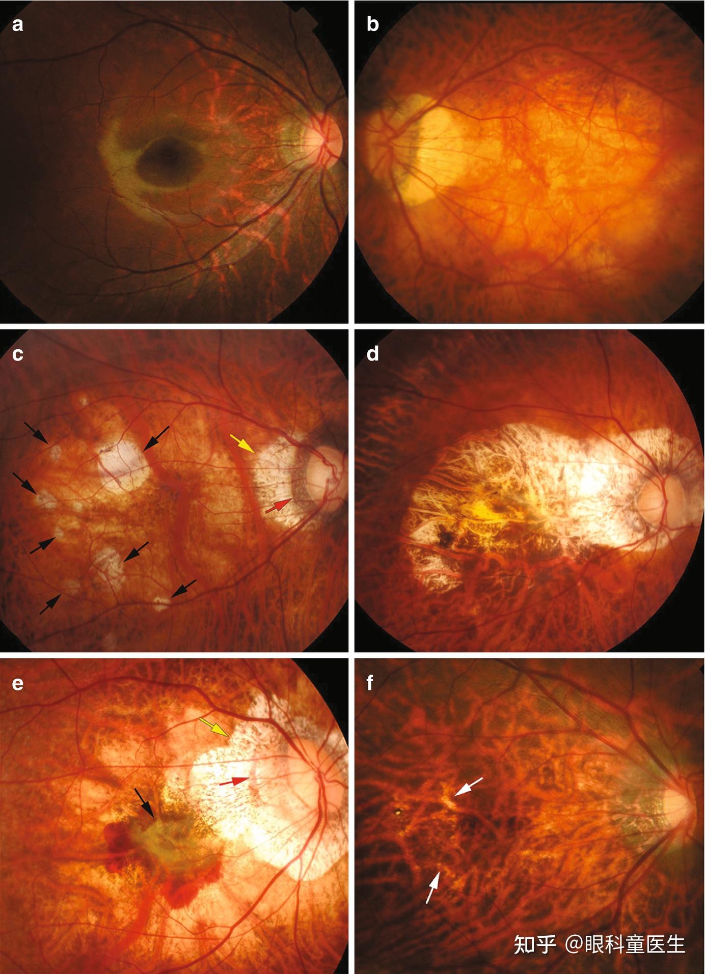 脉络膜的变性与营养不良性疾病——5,病理性近视的眼底改变