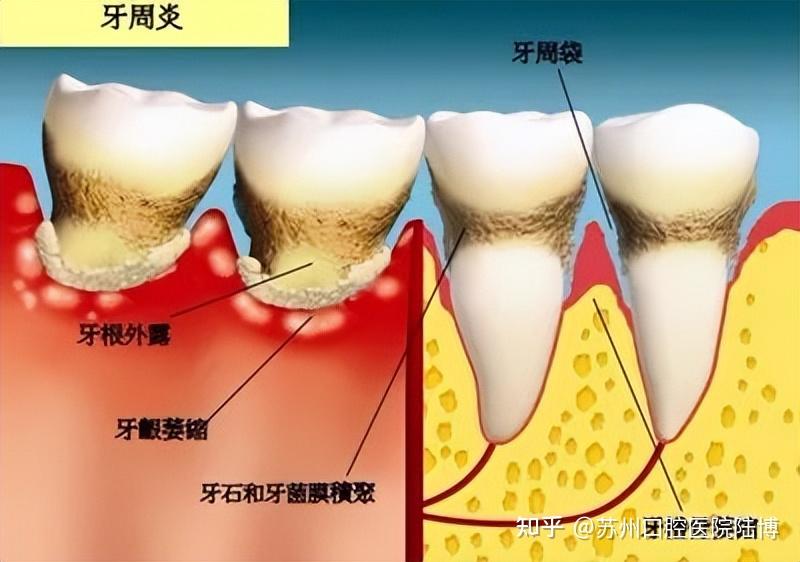 炎症可由牙龈向深层扩散到牙周膜,牙槽骨,进而发展为牙周炎