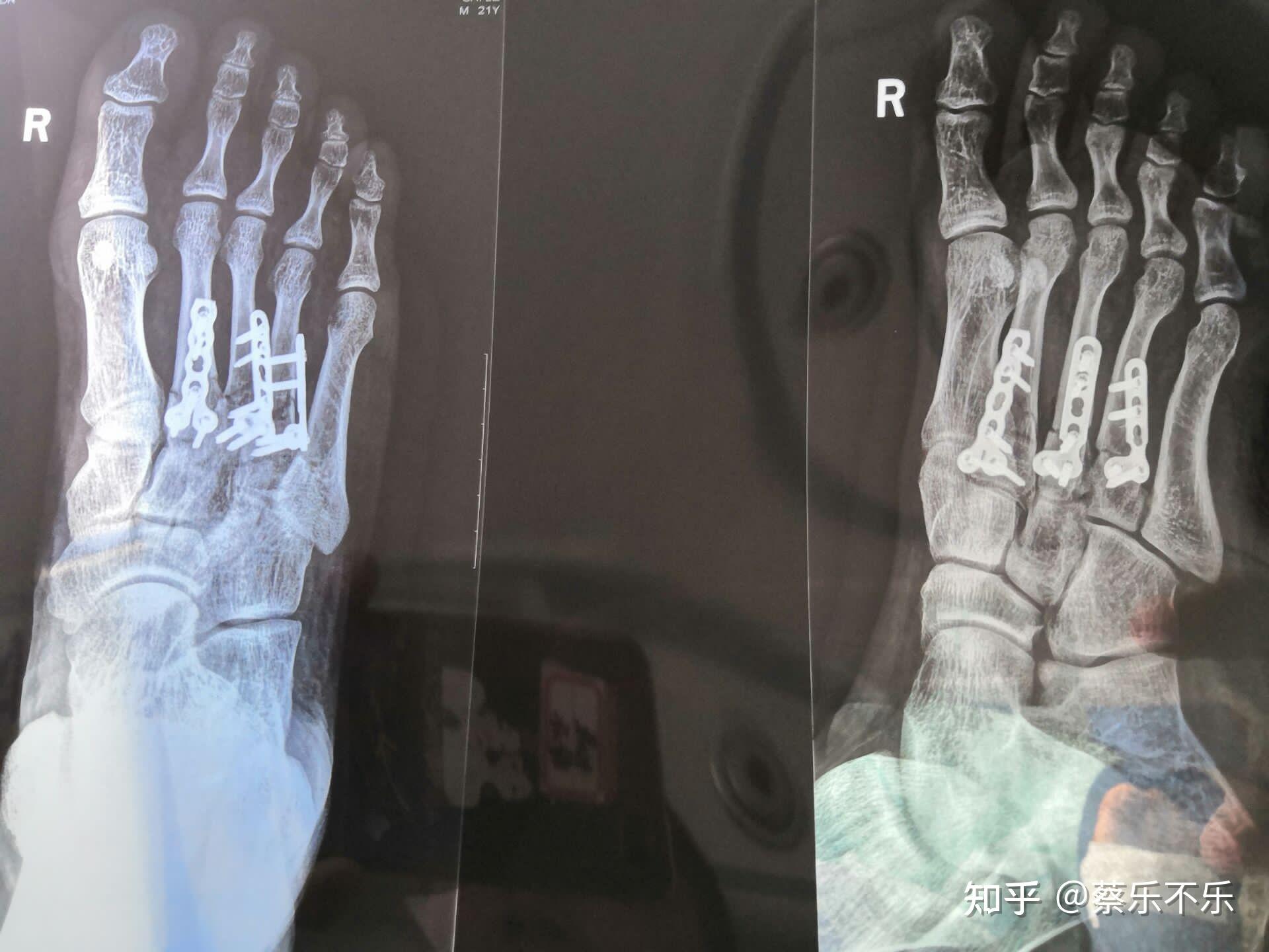 8日,做的右足跖骨第二三四切开内固定手术(就是打钢板)坐标武汉,四五