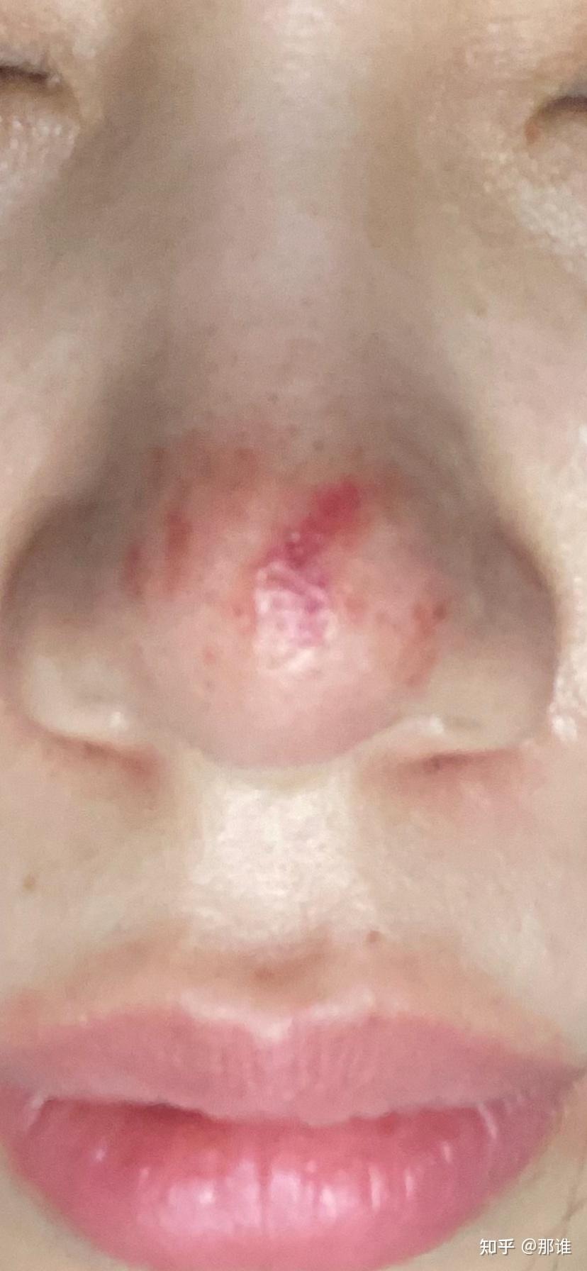 染料激光治疗酒糟鼻去红血丝2