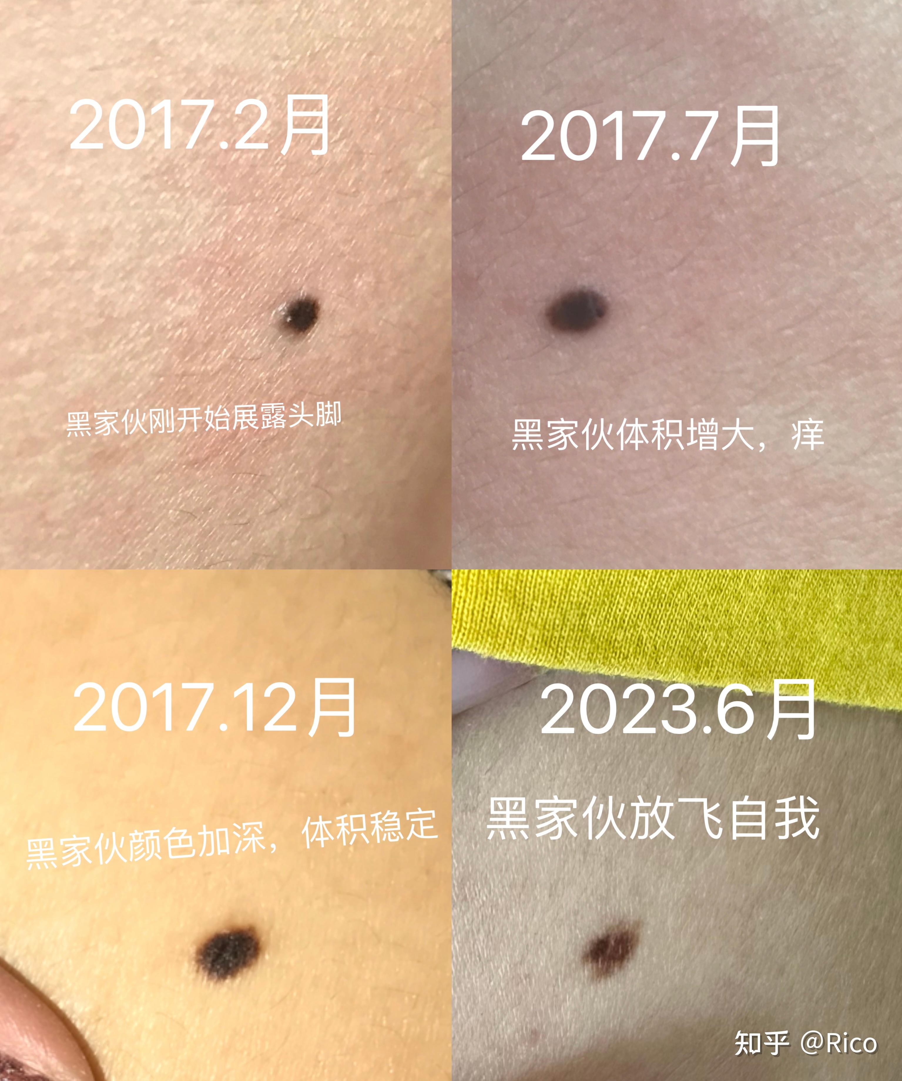 交界痣伴炎症,被黑色素瘤恐惧笼罩,终于尘埃落定 - 知乎