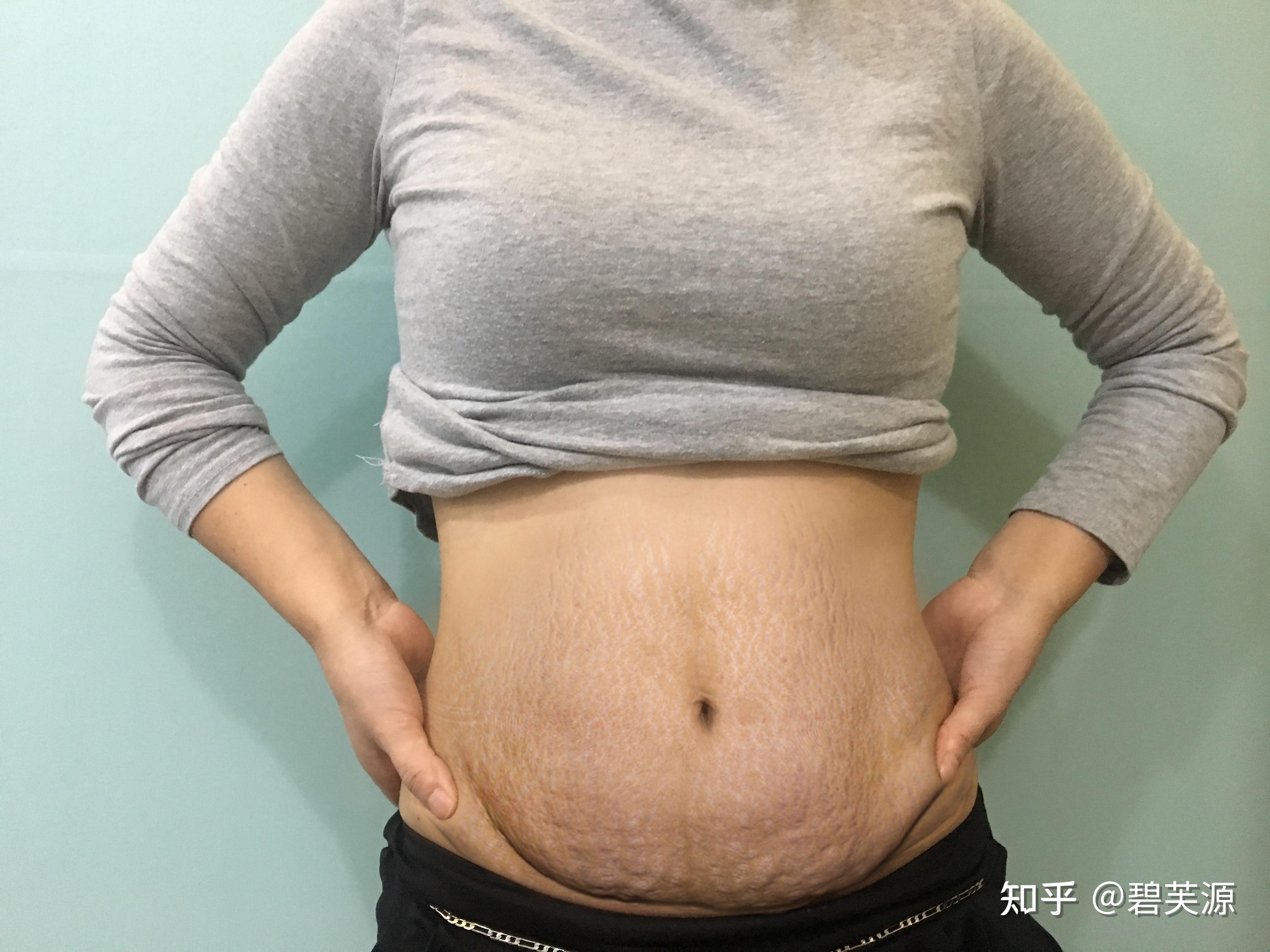 女人肚子有妊娠纹照片图片