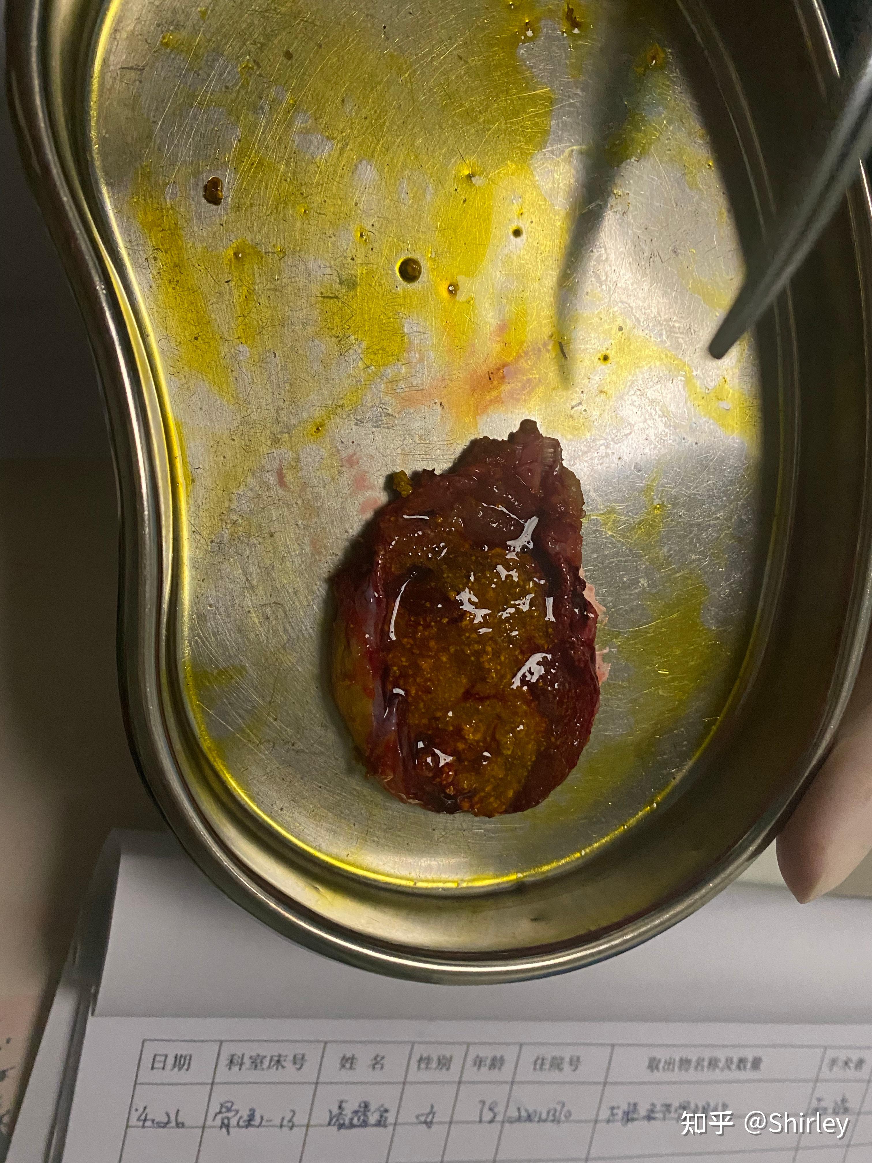 胆结石切除经历