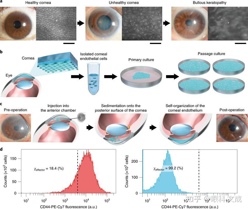 1角膜内皮细胞移植