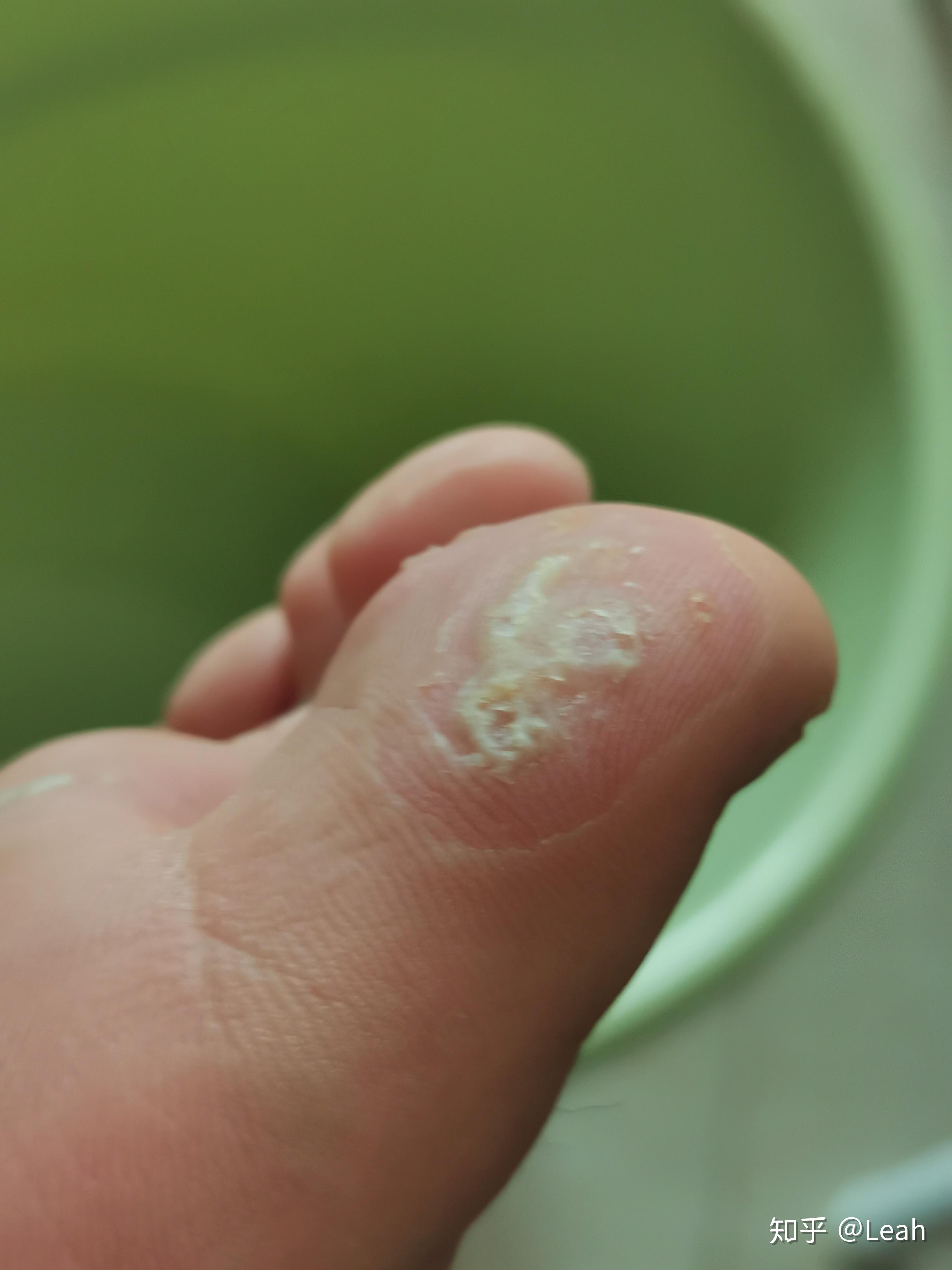 最近有小伙伴们问我斑蝥素乳膏的事,我总结了一下,像我去年涂的没有