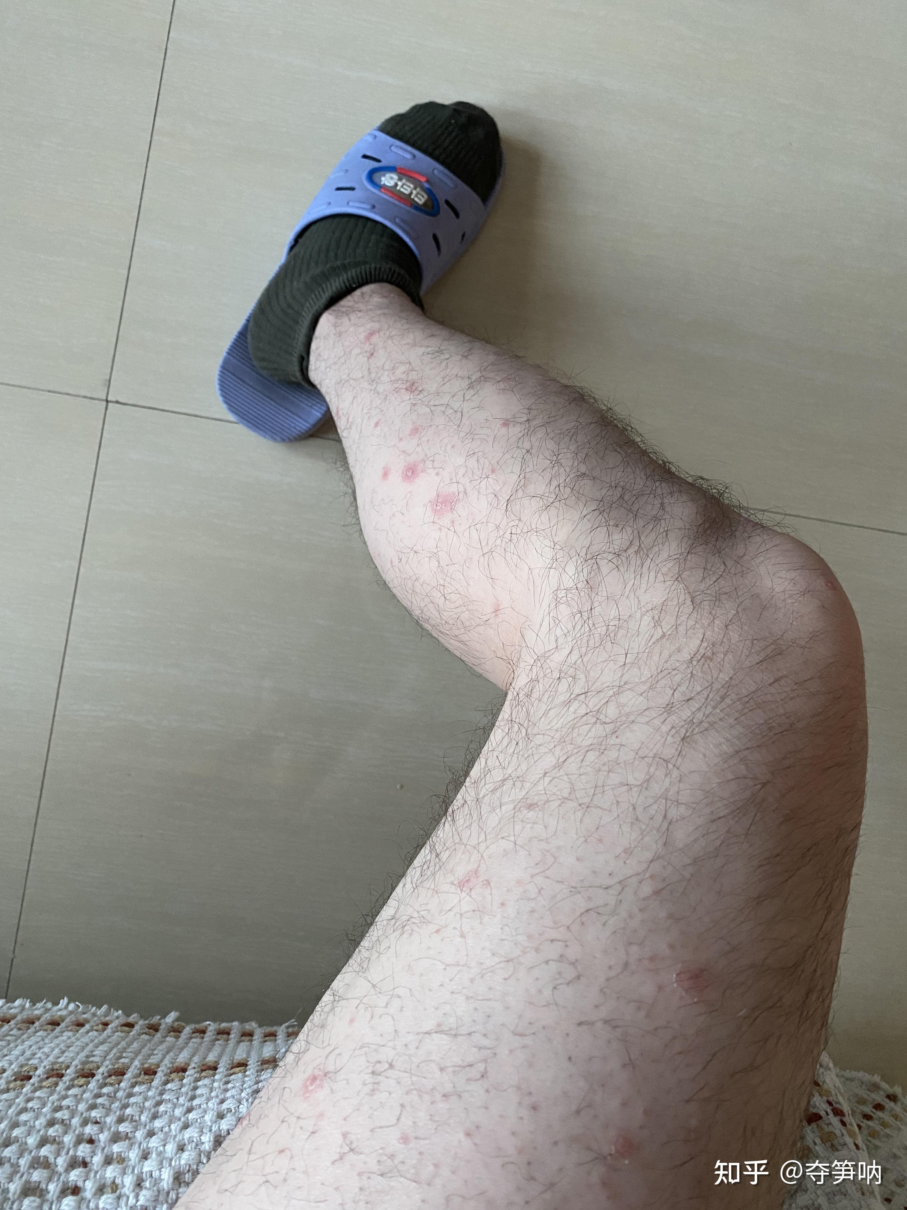 这几天银屑病皮损迅速消退