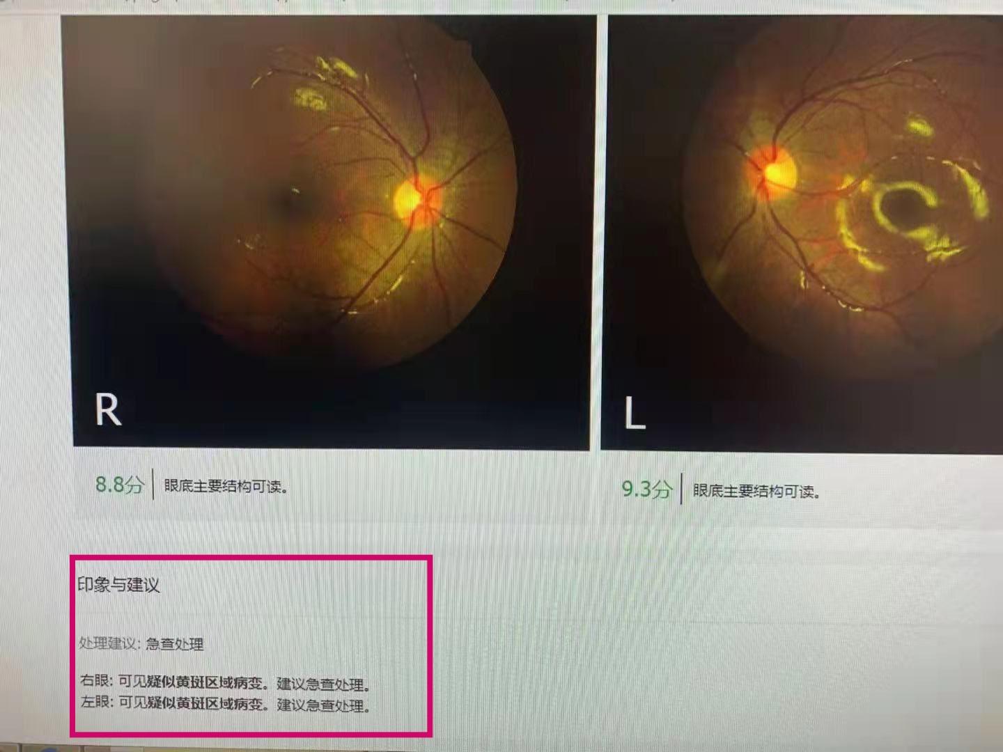 北京潘家园眼镜门店验光案例之哺光仪使用一年后的眼底照相诊断 - 知乎