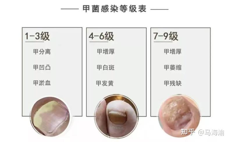 灰指甲怎么形成的原因 v2-ce800feb2587511667b9c9b11560f536_r.jpg