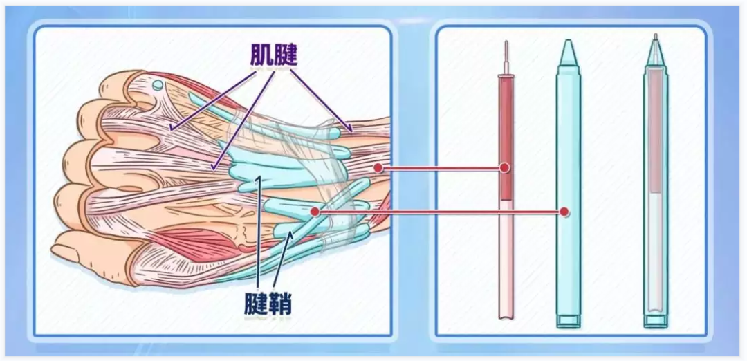 手腕不适小心是腱鞘炎1个动作快速自测