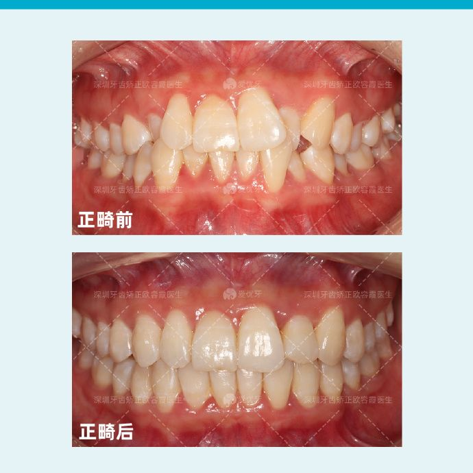 深圳牙齿矫正什么是隐形矫正隐形矫正有什么优点隐适美和时代天使有