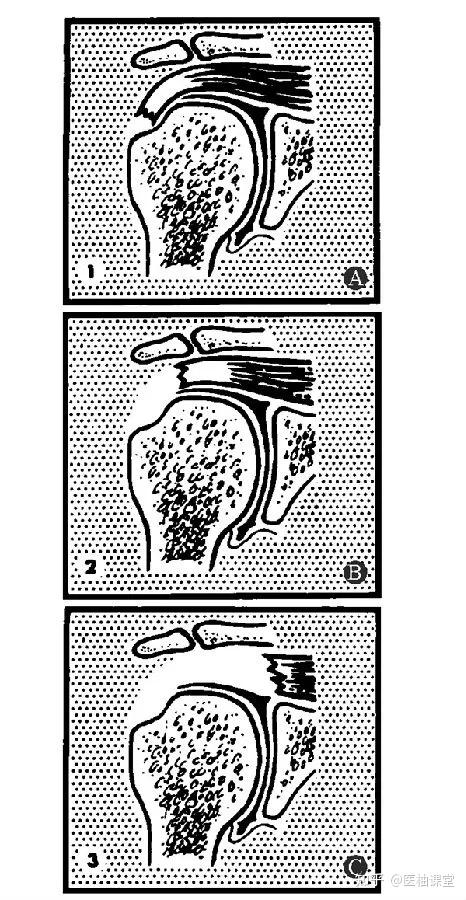 肩袖损伤分级图片