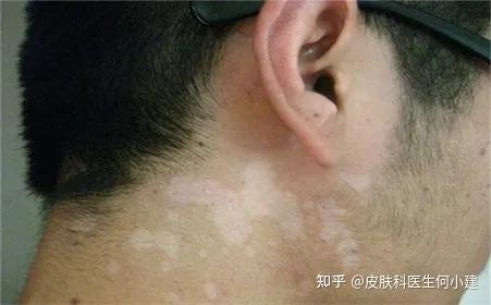 以上是我们比较常见的色斑种类,除此之外还有比如纹身,汗斑,血素斑,汞