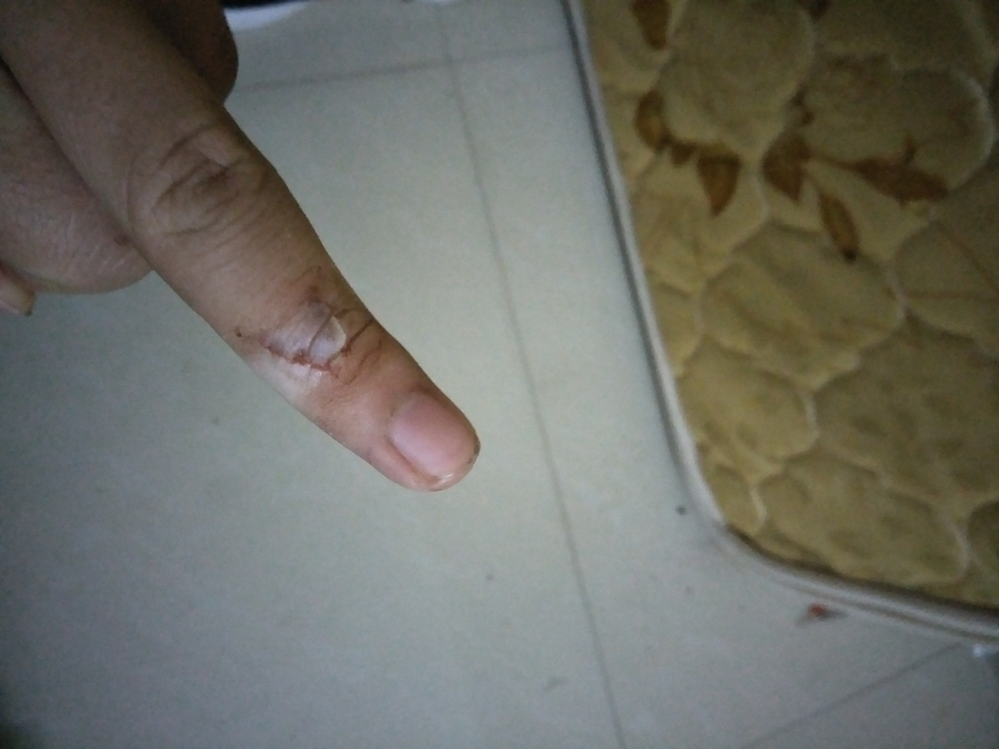 手指被剪刀剪了该怎么办