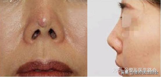 解密硅胶隆鼻包膜挛缩当硅胶假体被植入到鼻子后,免疫系统会发现其