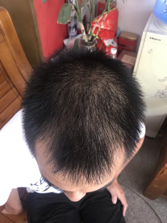 但是心里还是特别担心:回头会不会变成中年油腻大叔的地中海呢?