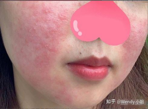 第一期：你长的真的是“痘痘”吗？ - 知乎