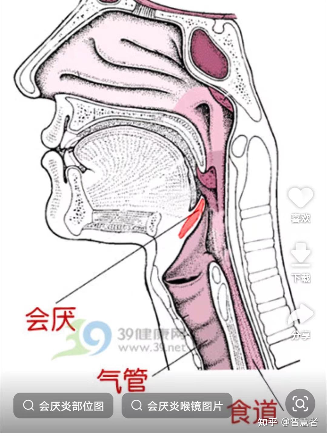 急性会厌炎是什么?真那么凶险吗? - 知乎