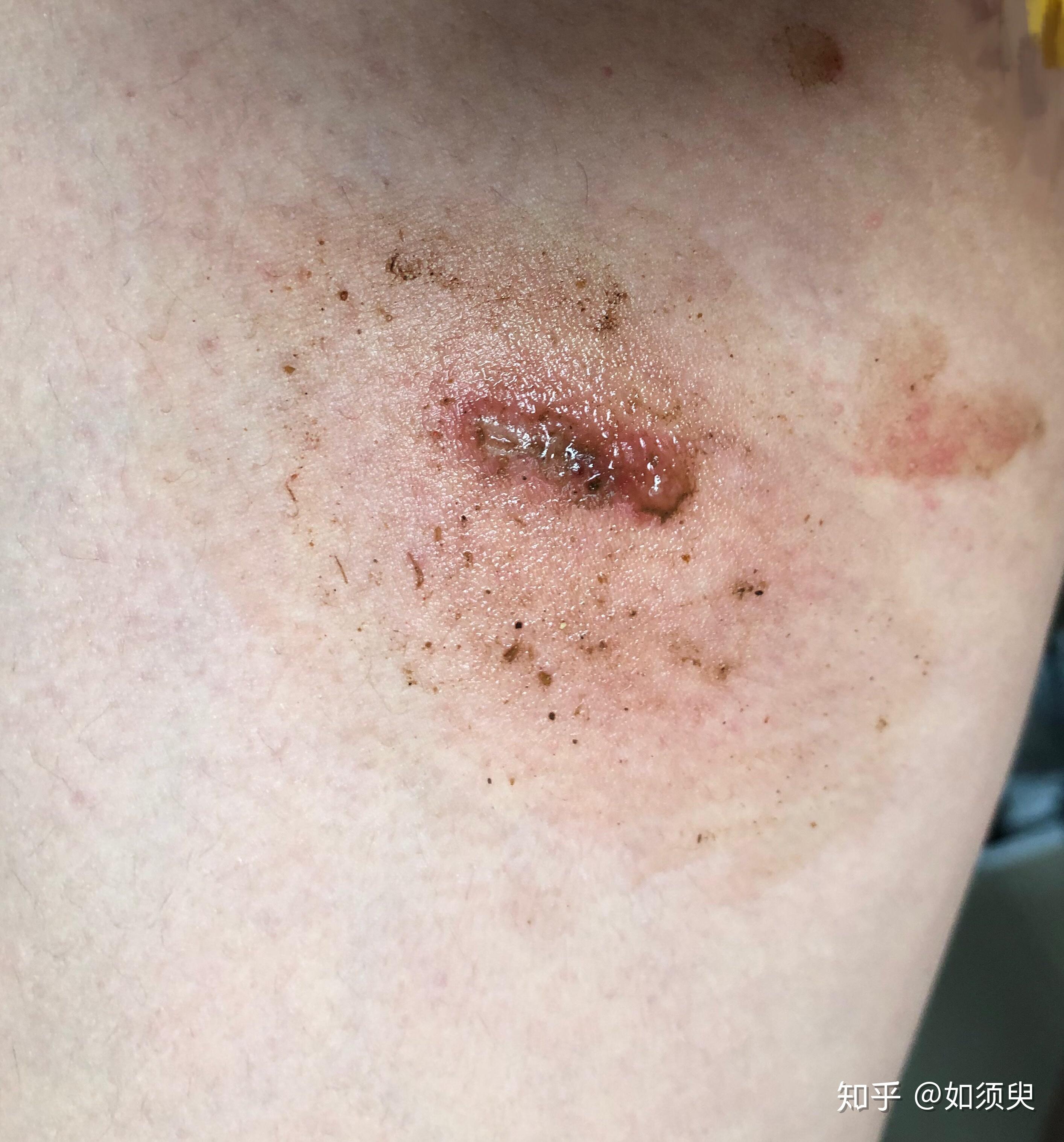 隐翅虫造成的伤口有什么特点